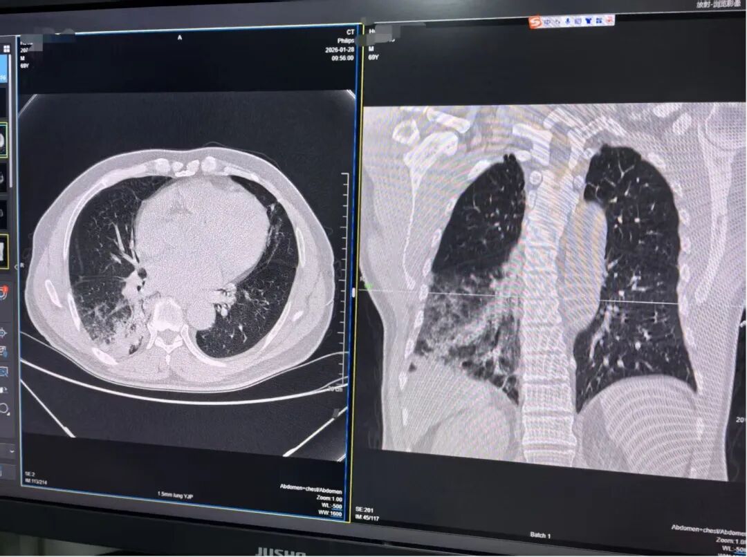 69岁男子养鸡鸭感染鹦鹉热，高烧不退！医生提醒