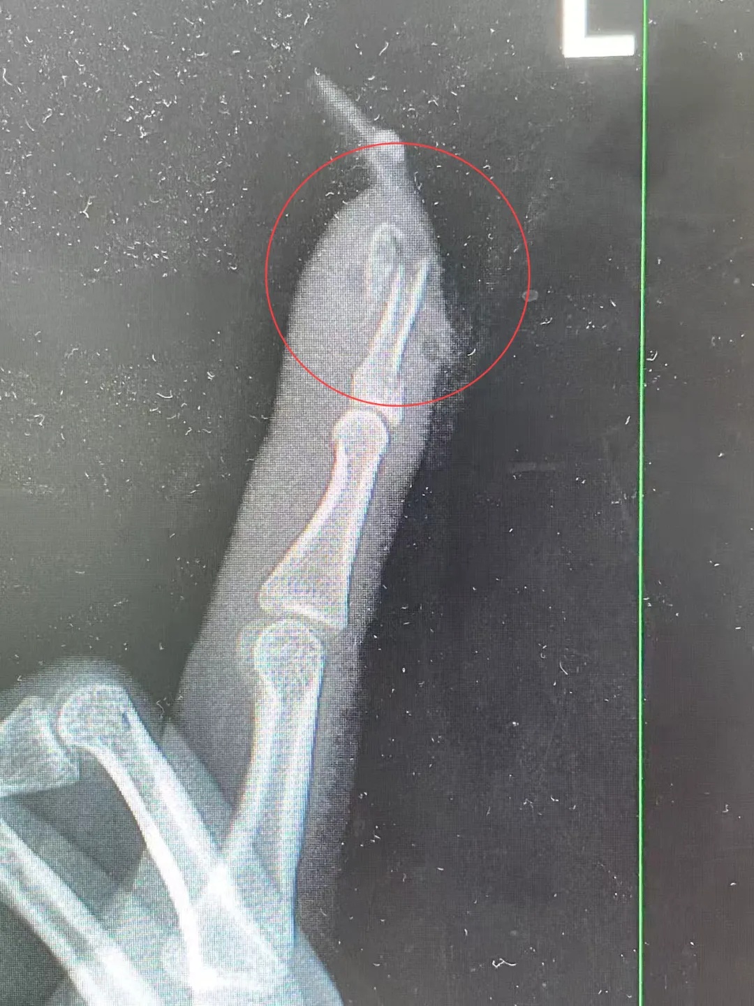 看着都疼！女子骑车摔了一跤，当场就断了！被誉为“过年三件套”，很多人赶着做