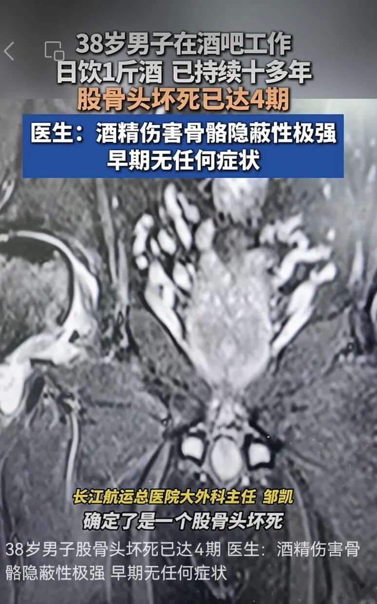 酒吧员工十年日饮一斤酒，股骨头坏死已达4期，医生提醒：饮酒不存在所谓安全量