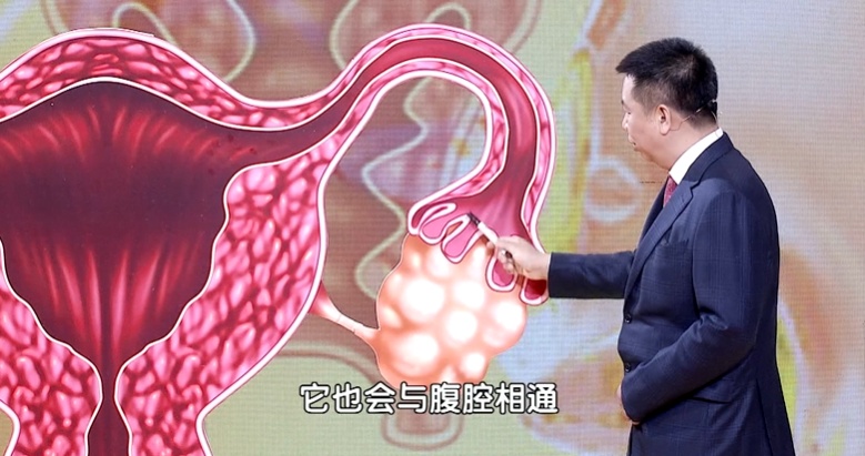 一种会装成“肠胃病”的癌，70%的人查出即晚期，很多人中招了还不知道