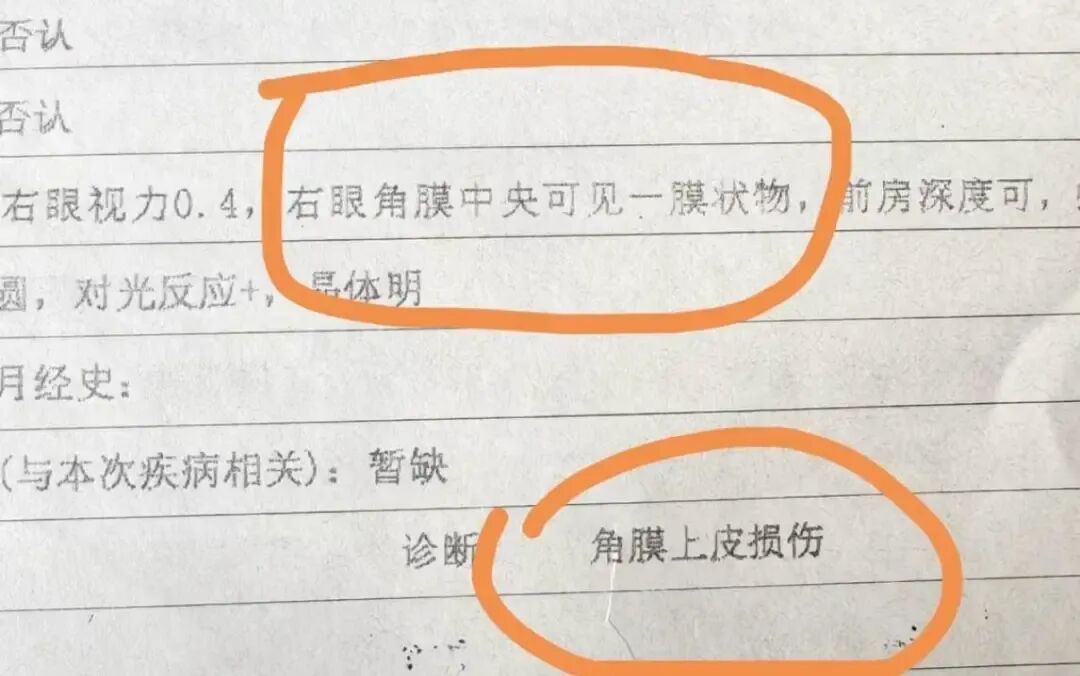 网友接完睫毛后出现右眼视力模糊,确诊角膜上皮损伤!医生提醒:避开这些坑 网友接完睫毛后出现右眼视力模糊,确诊角膜上皮损伤!医生提醒:避开这些坑