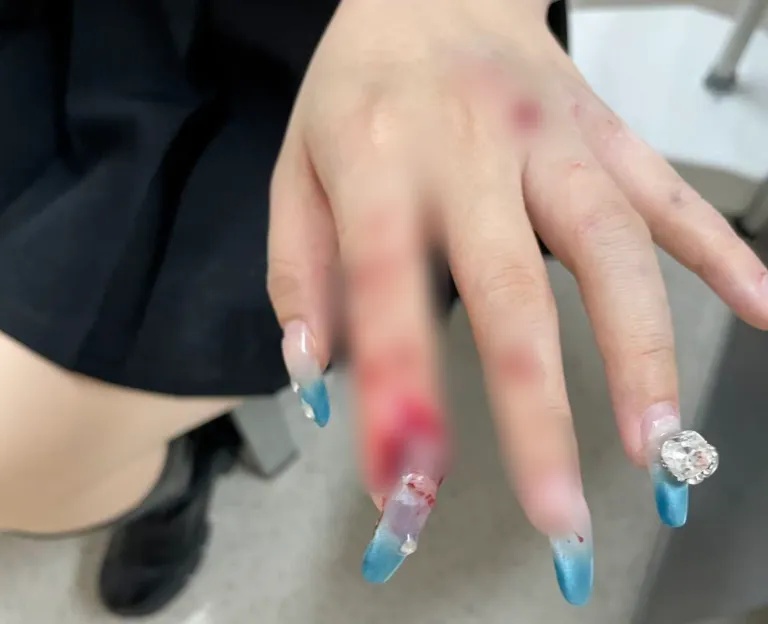 看着都疼！女子骑车摔了一跤，当场就断了！被誉为“过年三件套”，很多人赶着做