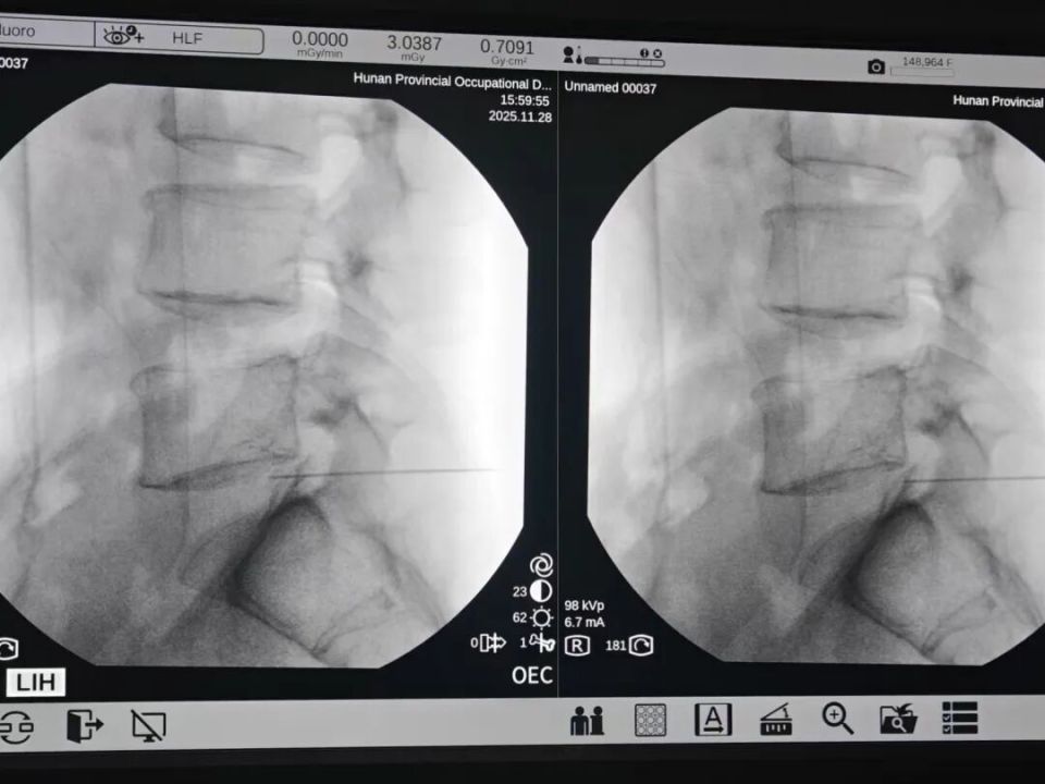 多年的腰突被一根针搞定了？长沙货车司机开车20多年长期腰痛，医生用一根针缓解