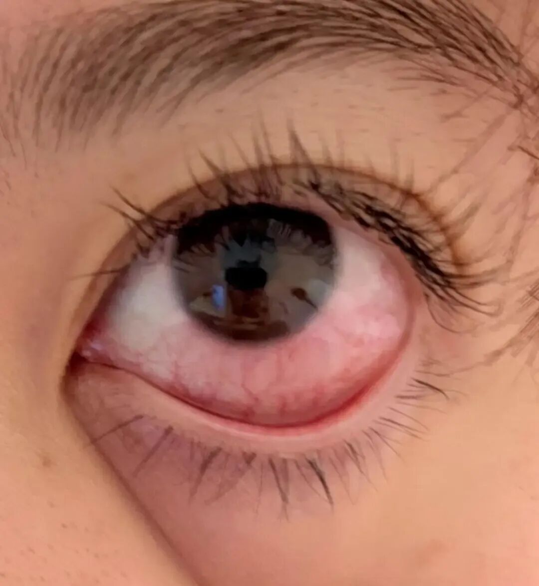 网友接完睫毛后出现右眼视力模糊,确诊角膜上皮损伤!医生提醒:避开这些坑 网友接完睫毛后出现右眼视力模糊,确诊角膜上皮损伤!医生提醒:避开这些坑