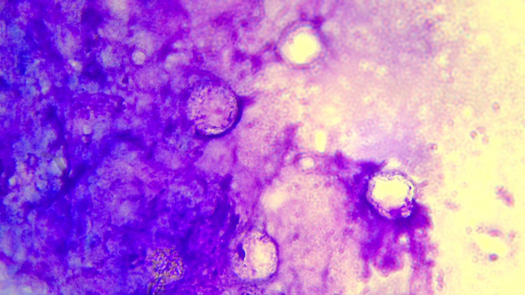 女子左眼剧痛、角膜穿孔,眼球差点不保!医生:感染“食脑虫” 女子左眼剧痛、角膜穿孔,眼球差点不保!医生:感染“食脑虫”