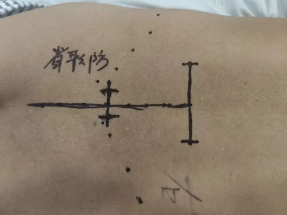 多年的腰突被一根针搞定了？长沙货车司机开车20多年长期腰痛，医生用一根针缓解