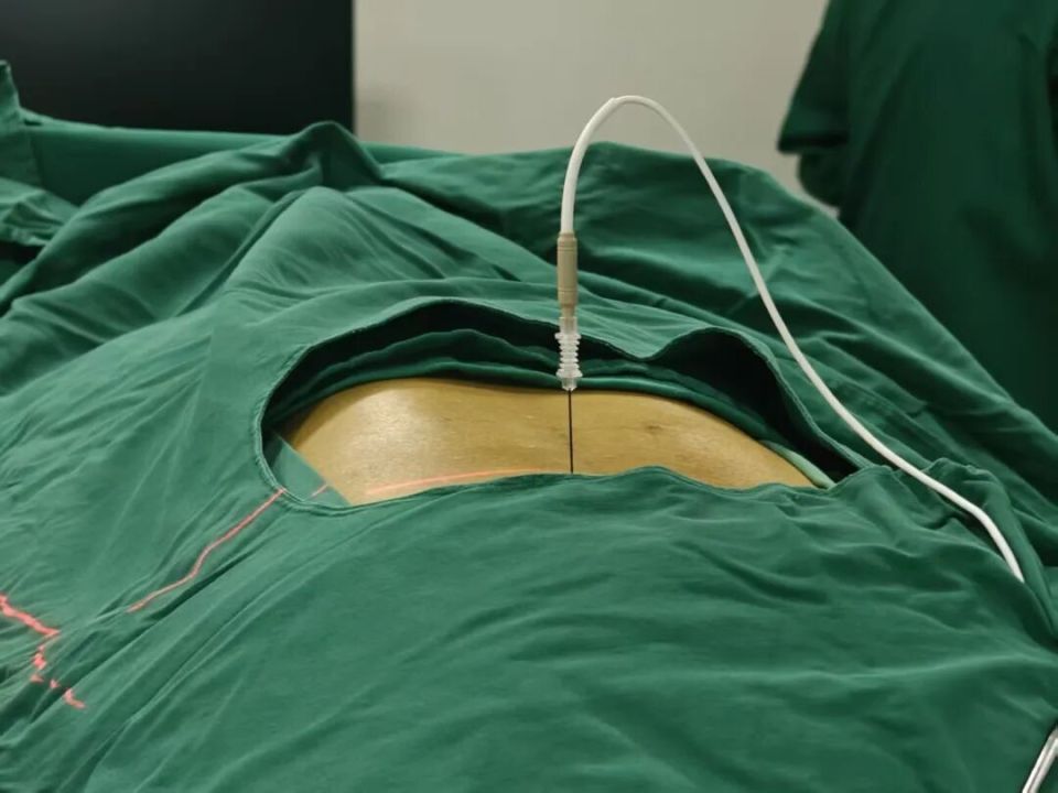 多年的腰突被一根针搞定了？长沙货车司机开车20多年长期腰痛，医生用一根针缓解