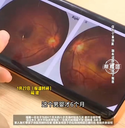 终生弱视！6个月大婴儿连续多日洗澡时直视浴霸灯光，右眼视网膜被灼伤，紧急提醒→
