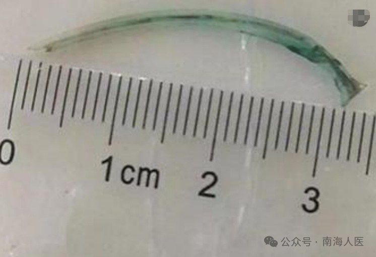 痛到流泪!因一个疏忽,佛山28岁小伙3厘米鱼刺卡“菊花”... 痛到流泪!因一个疏忽,佛山28岁小伙3厘米鱼刺卡“菊花”...