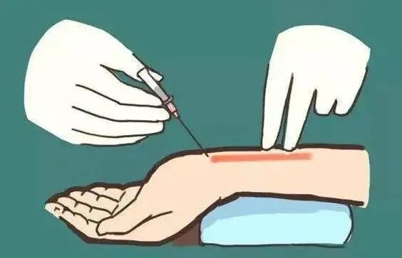 抽血不扎胳膊?为什么在手腕找来找去? 抽血不扎胳膊?为什么在手腕找来找去?