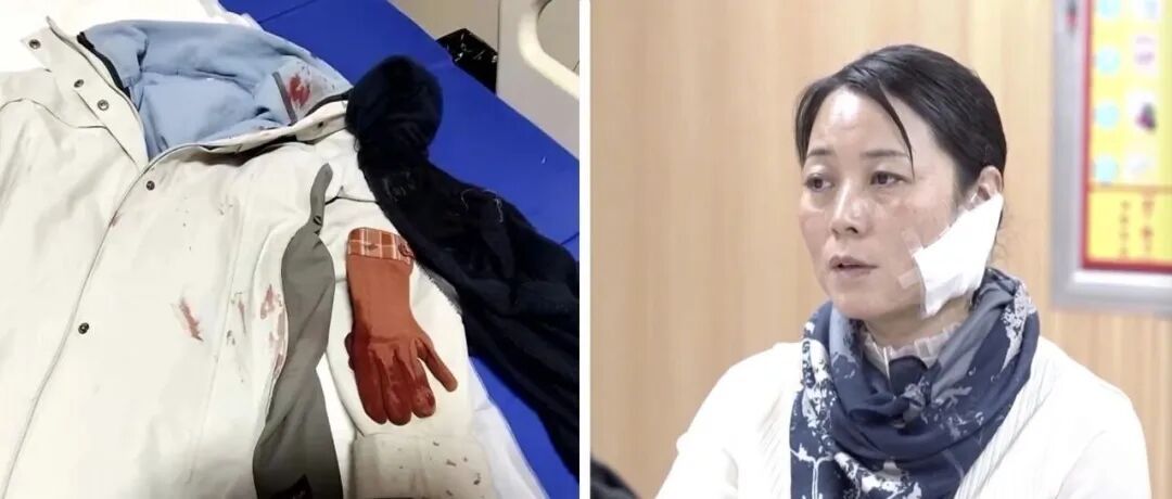 徒手夺刀制止行凶的女警，获表彰！医生：她面部缝合30余针，伤疤已无法恢复如初