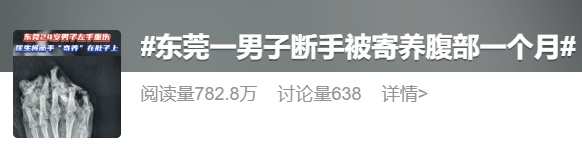 男子左手严重损毁，医生将断手“寄养”在肚子一个月