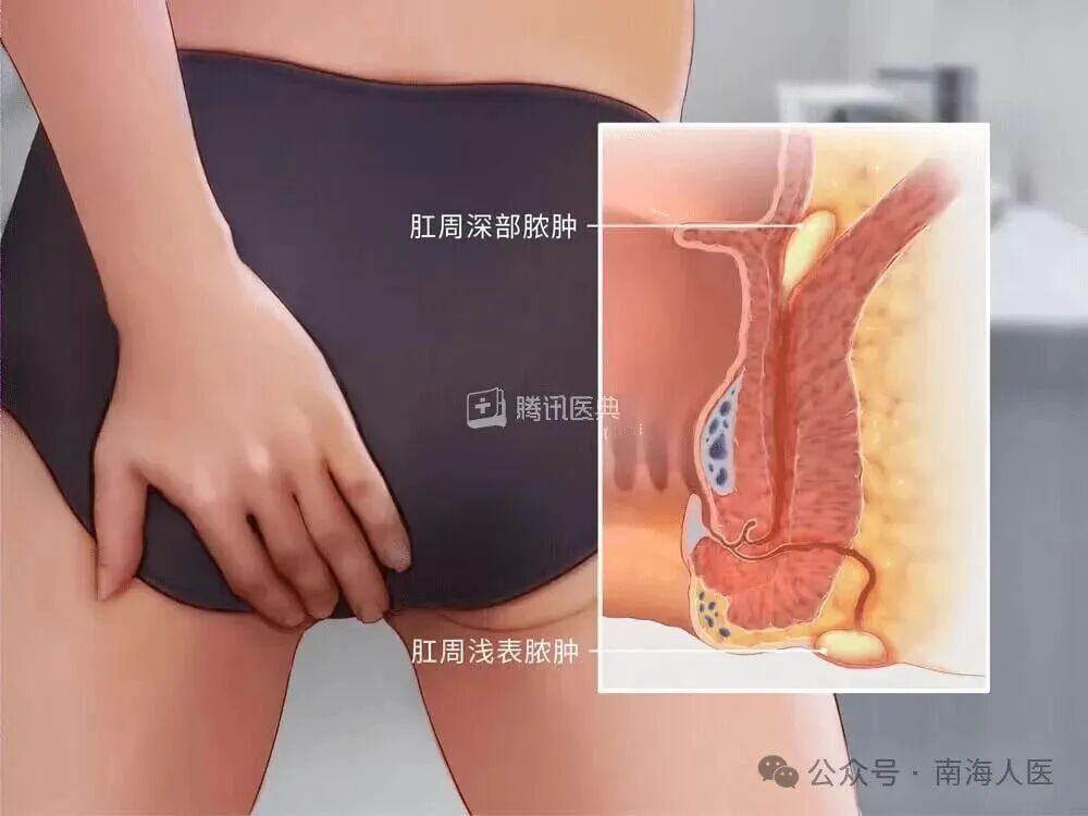 痛到流泪!因一个疏忽,佛山28岁小伙3厘米鱼刺卡“菊花”... 痛到流泪!因一个疏忽,佛山28岁小伙3厘米鱼刺卡“菊花”...