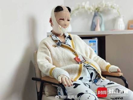 被前男友烧伤女子不认可其自首：是为了争取轻判