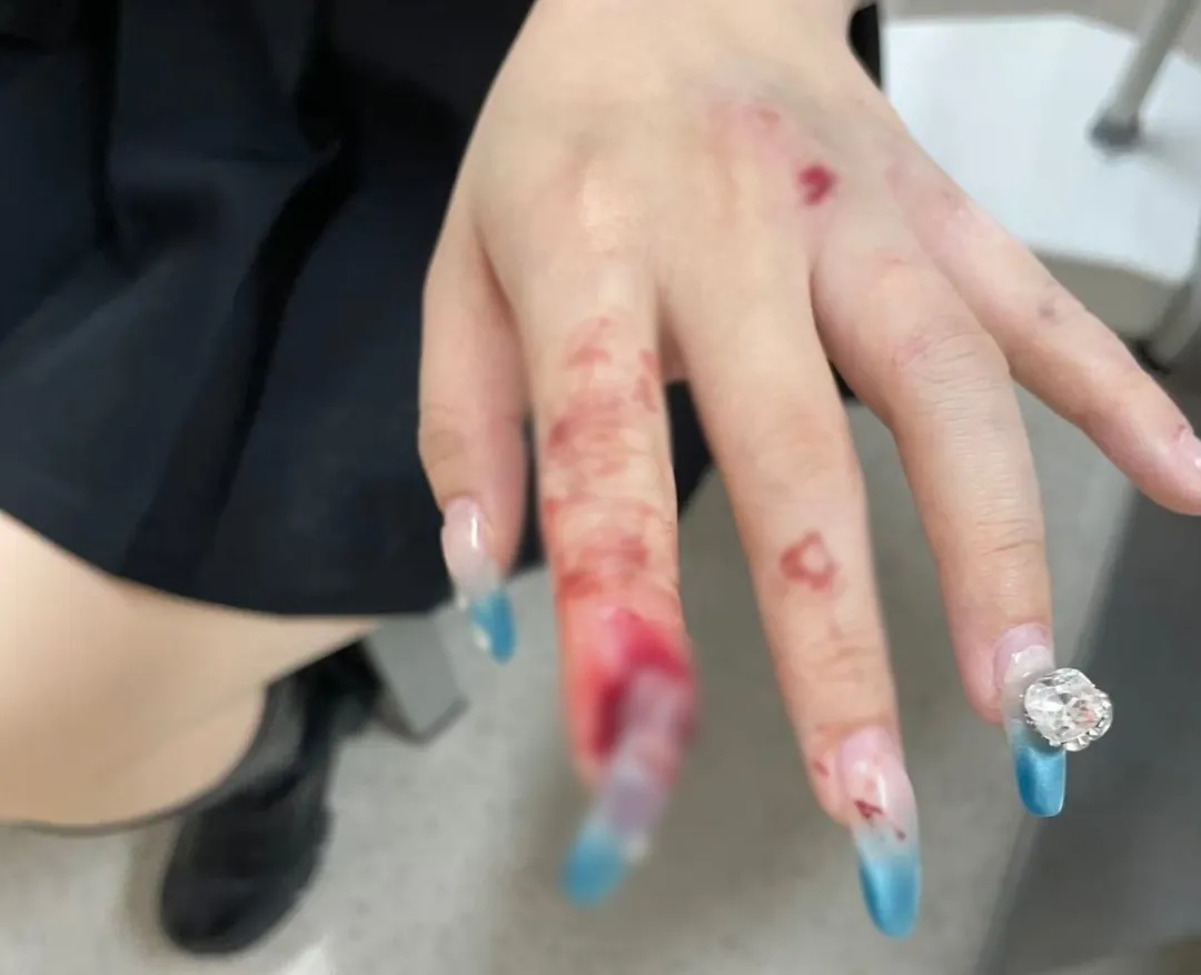 过年你做美甲了吗？新年战甲可能伤害力拉满，有女子因为美甲进了医院