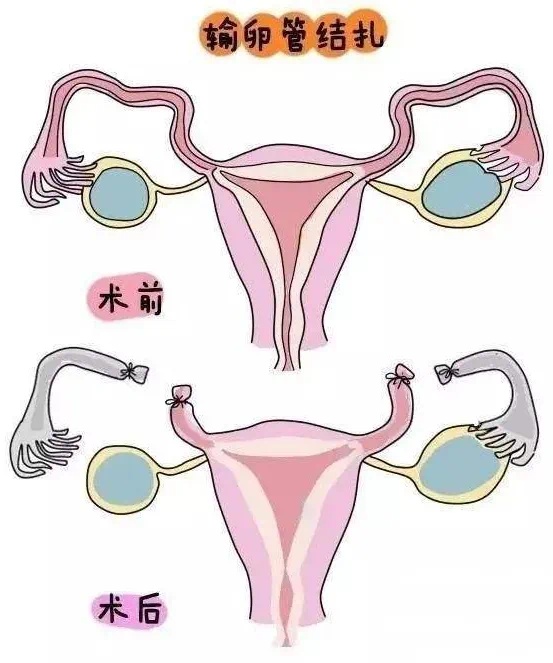 结扎手术后媳妇又怀孕！3孩父亲：我都懵了！医院：结扎手术复通，不逃避