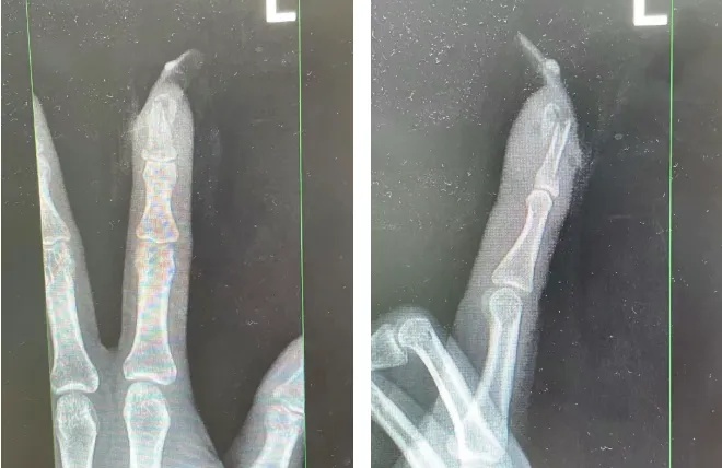 嘶~杭州女子指甲当场断裂!之前就有人因此进了医院…… 嘶~杭州女子指甲当场断裂!之前就有人因此进了医院……