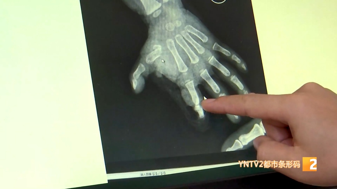 2岁男童玩鞭炮炸断手指！家里这个 “隐形杀手”，家长千万别大意