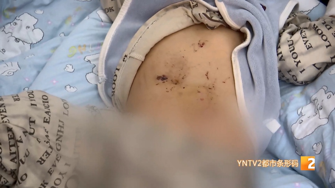 2岁男童玩鞭炮炸断手指！家里这个 “隐形杀手”，家长千万别大意