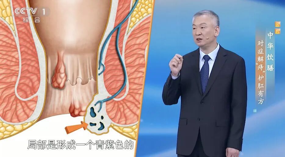 什么？洗屁股竟比洗脸还重要？肛肠科医生提醒，别忽略这里的健康！这样做帮你调理～