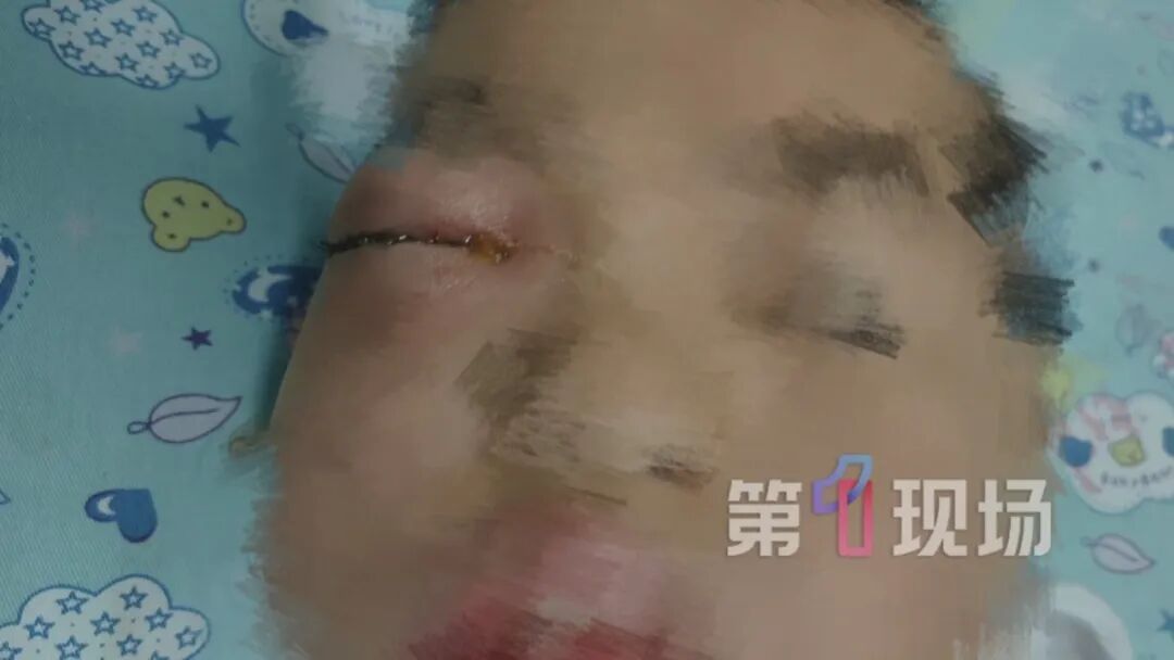 眼睛肿成“乒乓球”!六岁娃鼻腔长出囊肿,差点失明… 眼睛肿成“乒乓球”!六岁娃鼻腔长出囊肿,差点失明…