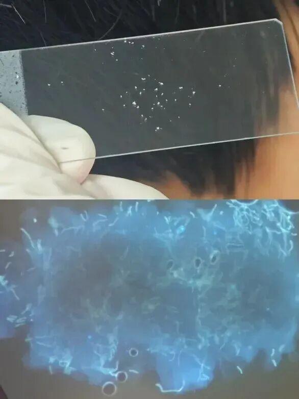 大腿根部、臀部发红发痒长小疙瘩脱皮，是得了湿疹？