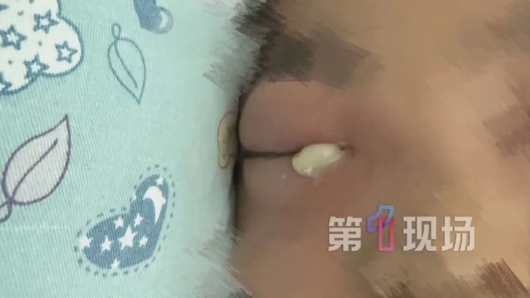 眼睛肿成“乒乓球”!六岁娃鼻腔长出囊肿,差点失明… 眼睛肿成“乒乓球”!六岁娃鼻腔长出囊肿,差点失明…