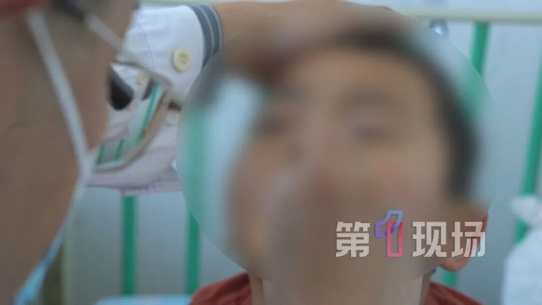 眼睛肿成“乒乓球”!六岁娃鼻腔长出囊肿,差点失明… 眼睛肿成“乒乓球”!六岁娃鼻腔长出囊肿,差点失明…