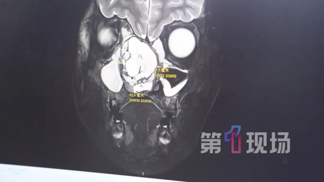 眼睛肿成“乒乓球”!六岁娃鼻腔长出囊肿,差点失明… 眼睛肿成“乒乓球”!六岁娃鼻腔长出囊肿,差点失明…