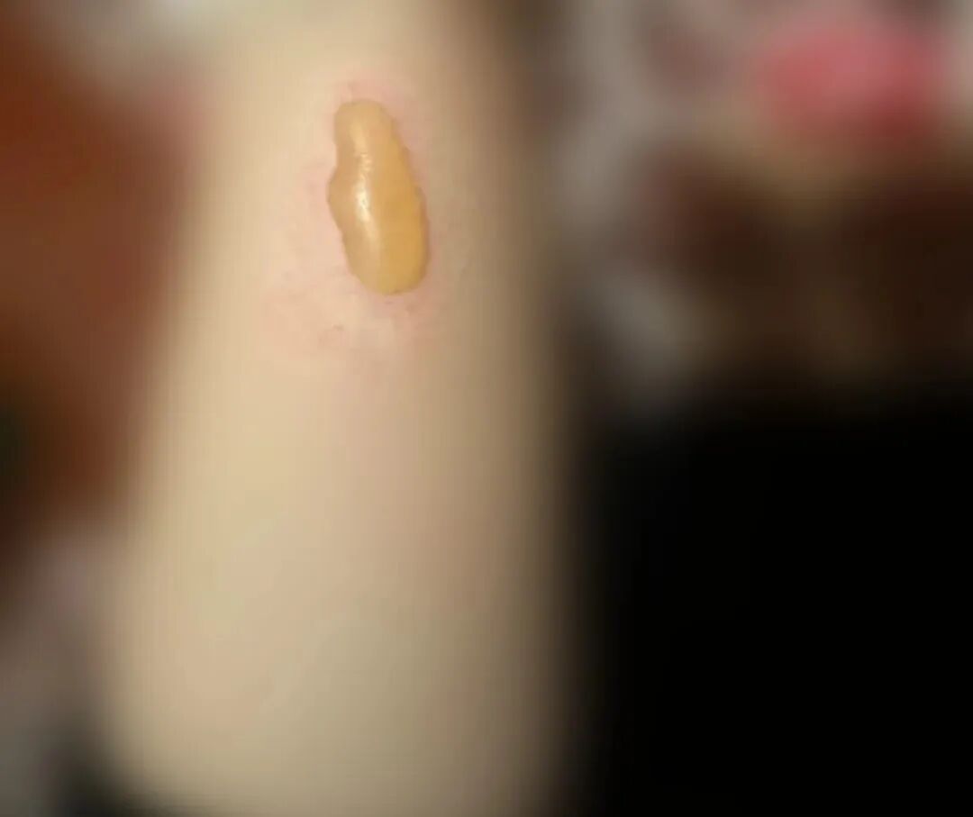 一觉睡醒长出大水泡!这个习惯很多人有,已进入高发期 一觉睡醒长出大水泡!这个习惯很多人有,已进入高发期