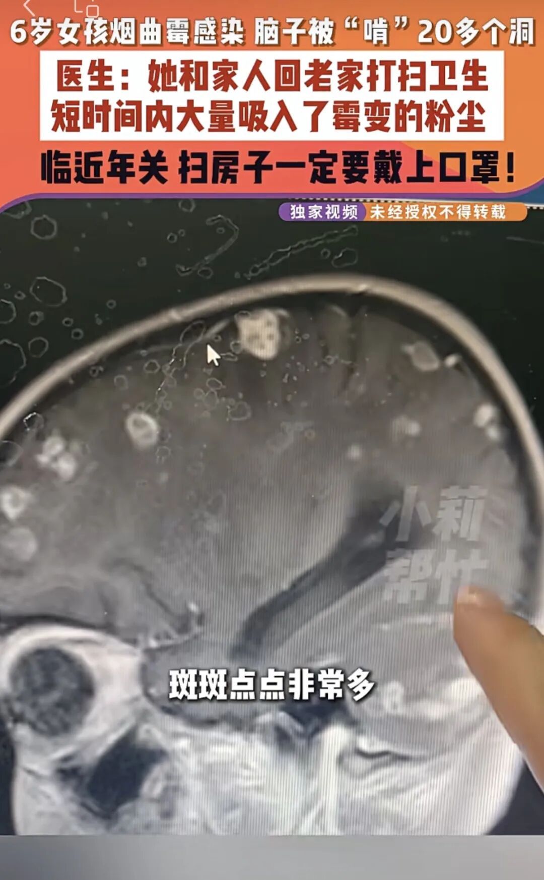 年前“大扫除”要警惕!6岁女孩发烧17天,医生提醒→ 年前“大扫除”要警惕!6岁女孩发烧17天,医生提醒→