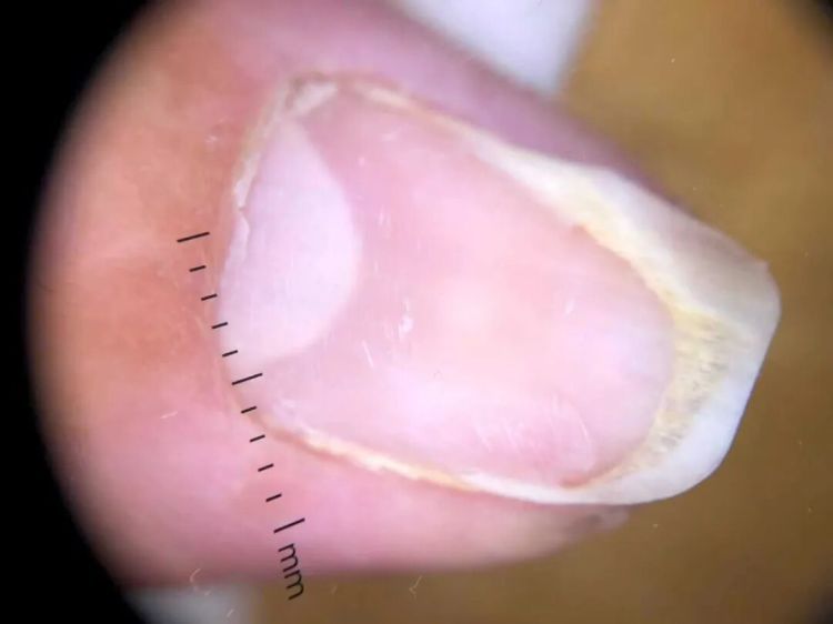 23岁女生每月做美甲，结果指甲被‘扒光’？医生：这层皮千万不能动！