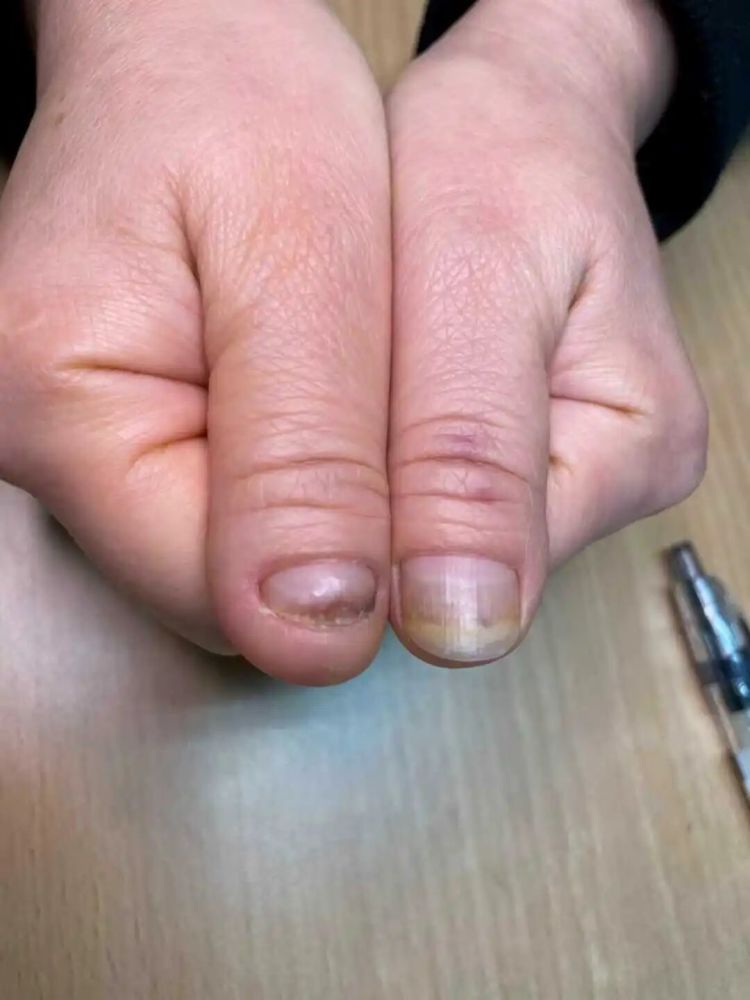 23岁女生每月做美甲，结果指甲被‘扒光’？医生：这层皮千万不能动！