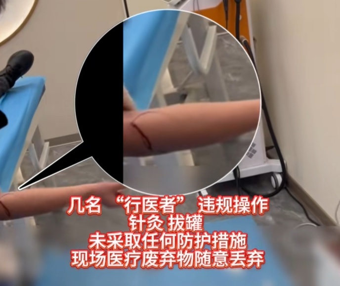 触目惊心！长针刺入皮肤，黑诊所血流满地，操作者却说在“排邪气”