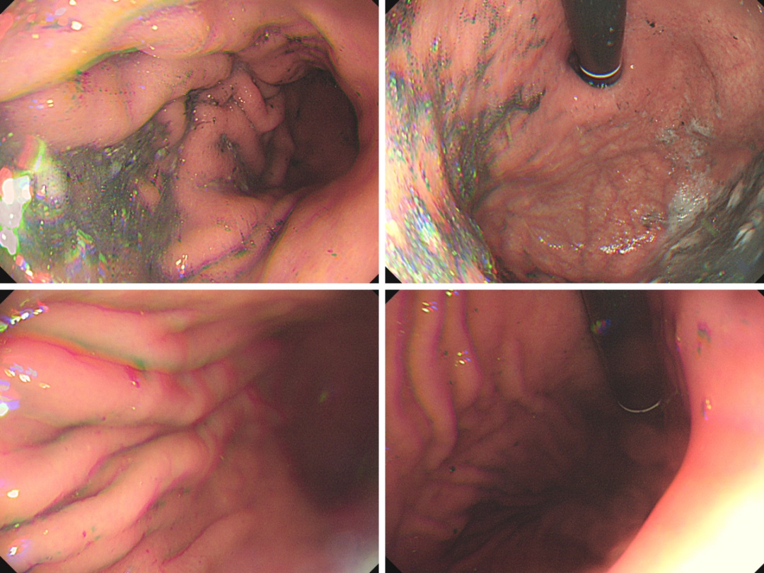 一杯下肚，杭州奶奶直接进急诊，“以为那是芝麻糊…”医生：胃里全是“致密影”