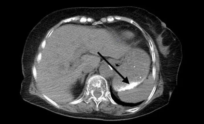 一杯下肚，杭州奶奶直接进急诊，“以为那是芝麻糊…”医生：胃里全是“致密影”