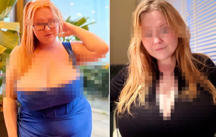 胸部疯长至35斤！女子服减肥药后确诊罕见巨乳症