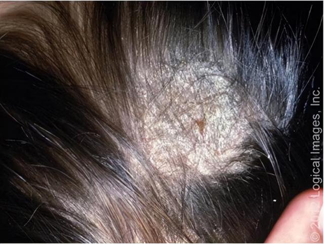 救命!头皮上抠出来的“白泥”到底是啥?会把头抠秃吗? 救命!头皮上抠出来的“白泥”到底是啥?会把头抠秃吗?