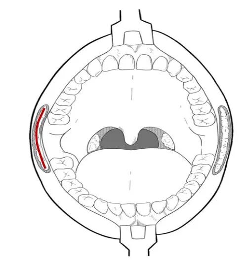 女子磕到下巴导致面部骨折！医生在“嘴里”给她做手术
