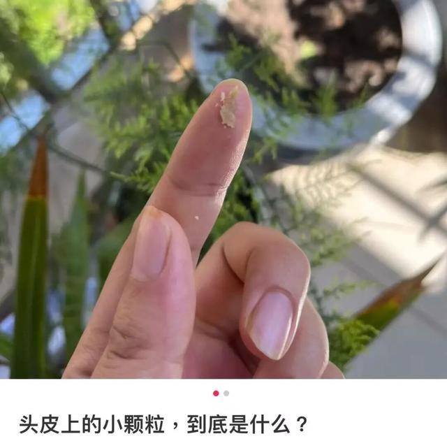 救命!头皮上抠出来的“白泥”到底是啥?会把头抠秃吗? 救命!头皮上抠出来的“白泥”到底是啥?会把头抠秃吗?
