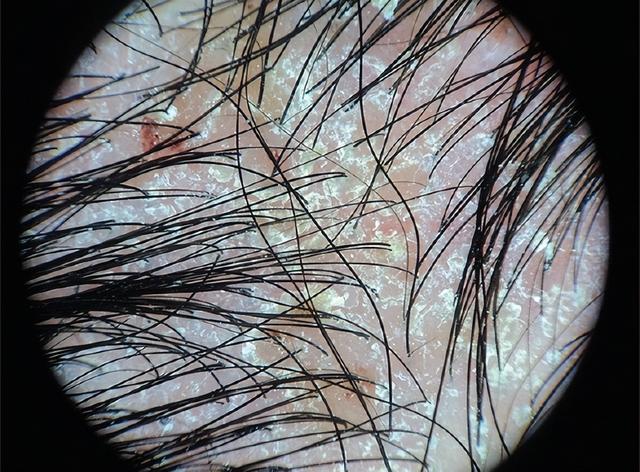 救命!头皮上抠出来的“白泥”到底是啥?会把头抠秃吗? 救命!头皮上抠出来的“白泥”到底是啥?会把头抠秃吗?