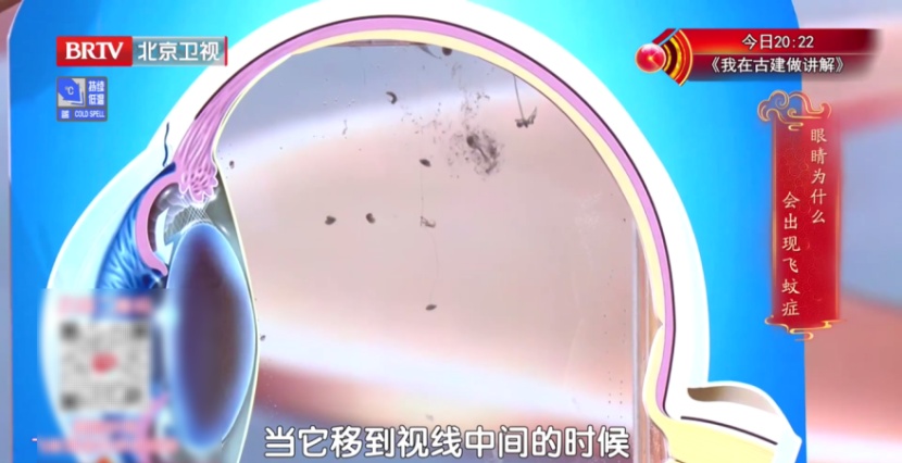 搬个行李竟差点失明？有高度近视+飞蚊症状的人要小心