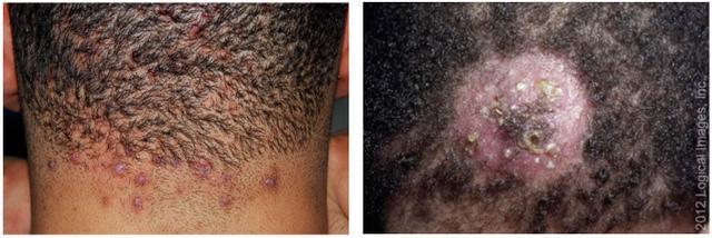 救命!头皮上抠出来的“白泥”到底是啥?会把头抠秃吗? 救命!头皮上抠出来的“白泥”到底是啥?会把头抠秃吗?