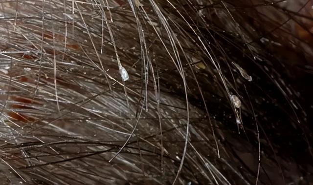 救命!头皮上抠出来的“白泥”到底是啥?会把头抠秃吗? 救命!头皮上抠出来的“白泥”到底是啥?会把头抠秃吗?