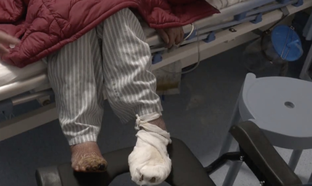 九旬老人左脚成“黑蹄子”，原来是下肢动脉闭塞导致……