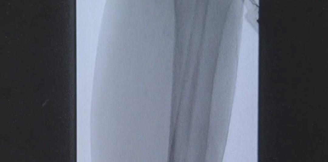 九旬老人左脚成“黑蹄子”，原来是下肢动脉闭塞导致……