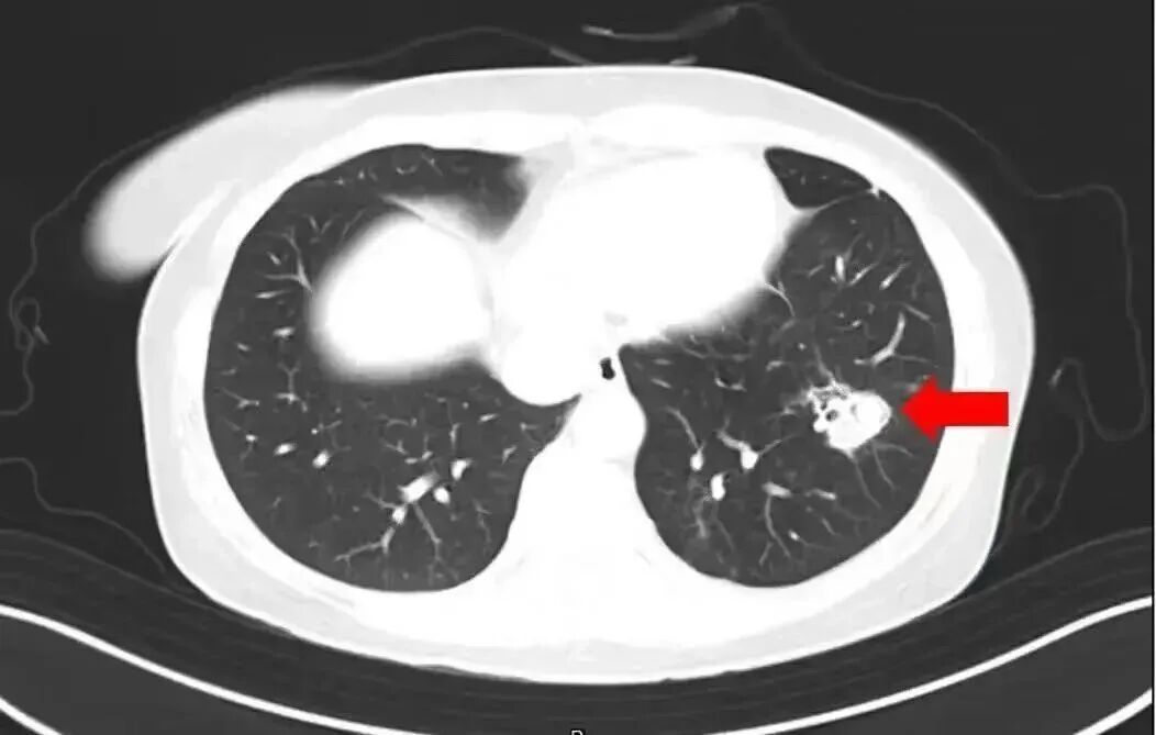 跟随家人扫房子后，6岁女孩脑部被感染！还有这些隐患一定注意……