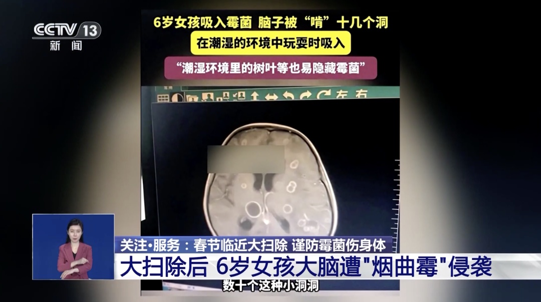 郑州一女孩跟随家人打扫房子后，脑部被感染！医生：霉变粉尘中的“烟曲霉”导致