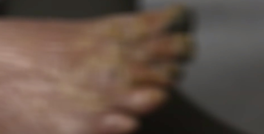 九旬老人左脚成“黑蹄子”，原来是下肢动脉闭塞导致……