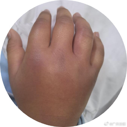 8岁男孩被笔戳伤现感染性休克